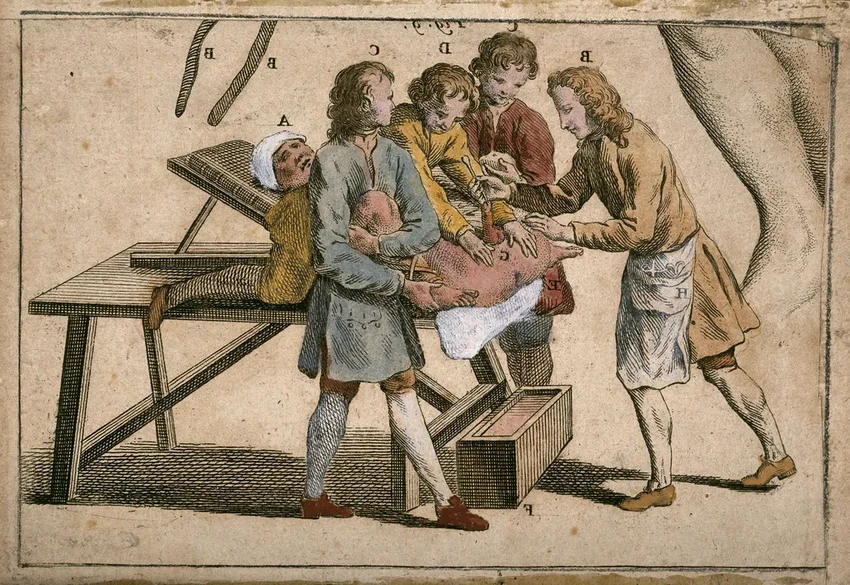 Литотомия: как в прошлом удаляли камни без анестезии и антисептиков