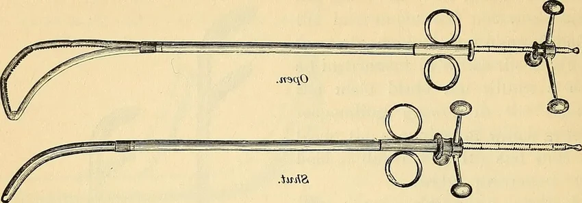 Литотомия: как в прошлом удаляли камни без анестезии и антисептиков