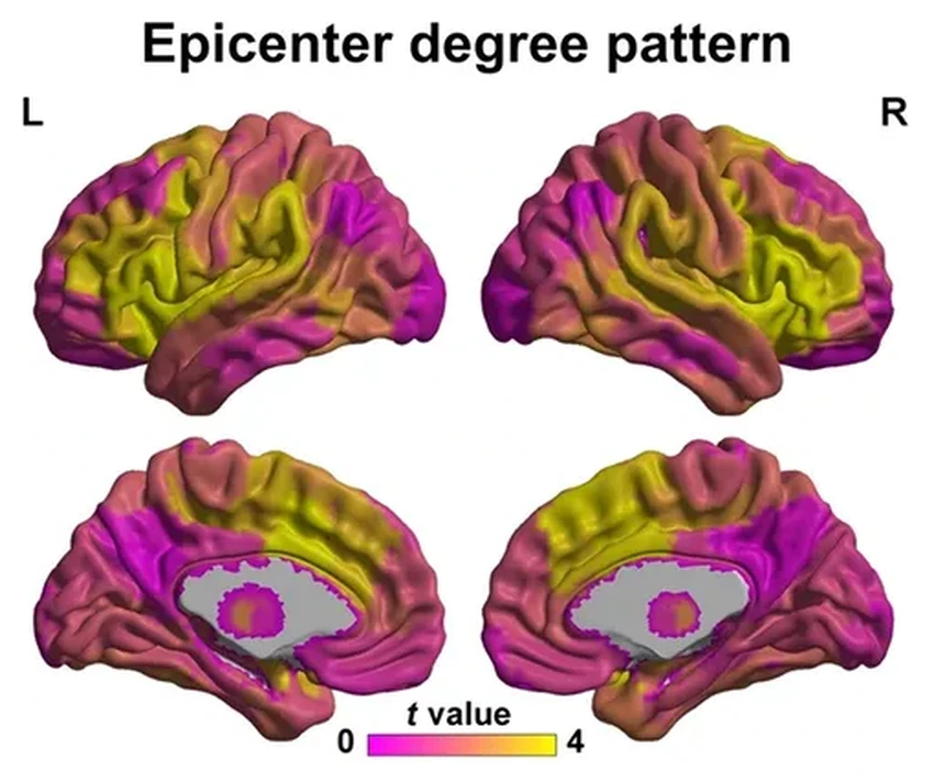 Два очага в мозге: откуда начинается шизофрения