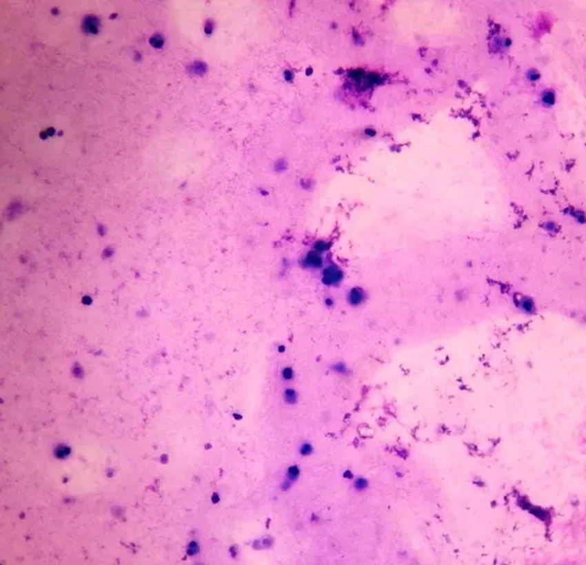 Новый анализ крови позволяет оценить риск мужского бесплодия