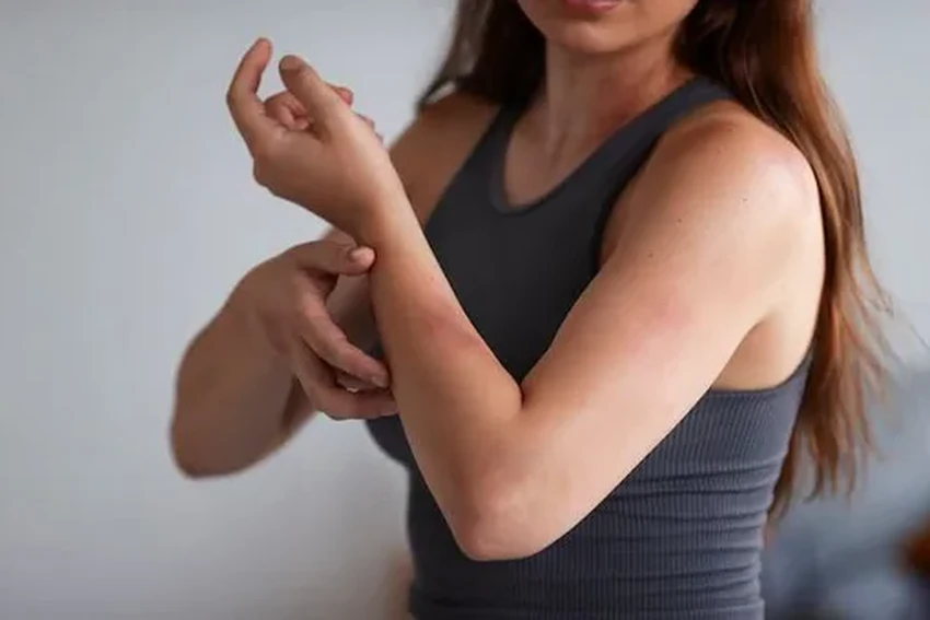 Чем снять зуд от укуса комара: аптечные и народные средства