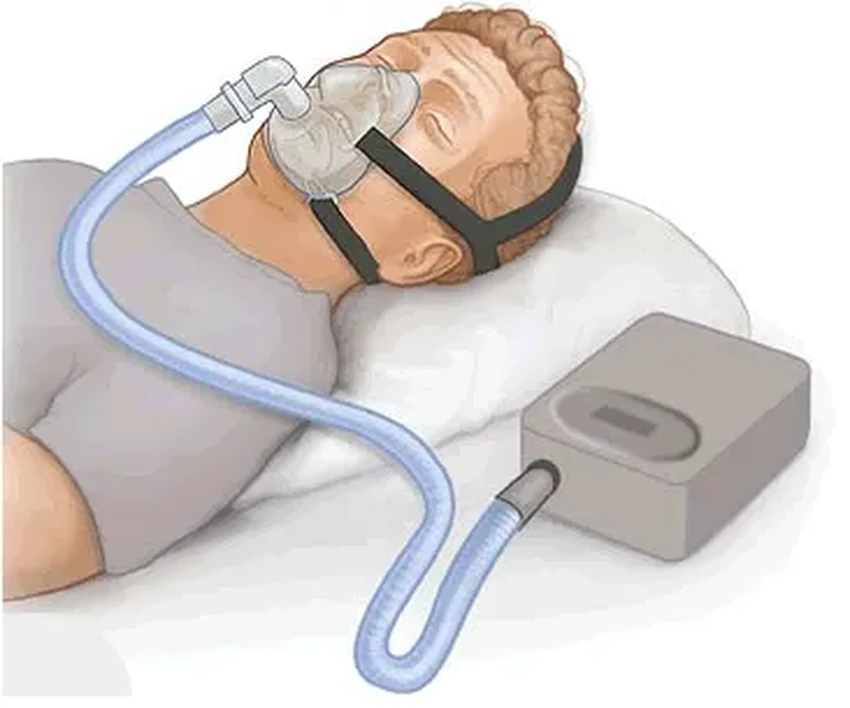 Препарат для снижения веса тирзепатид оказался эффективным средством от апноэ сна