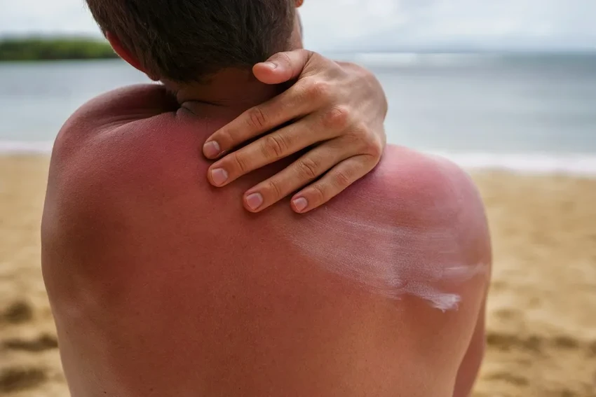 Как защитить кожу от солнца: правила эффективной защиты от ультрафиолета