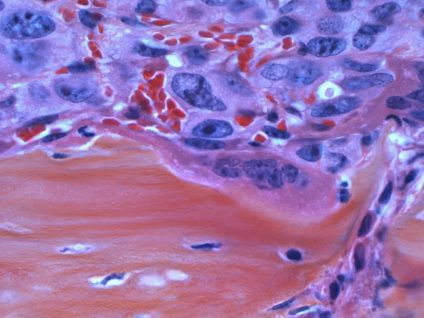 Как голодание помогает иммунитету бороться с раковыми клетками