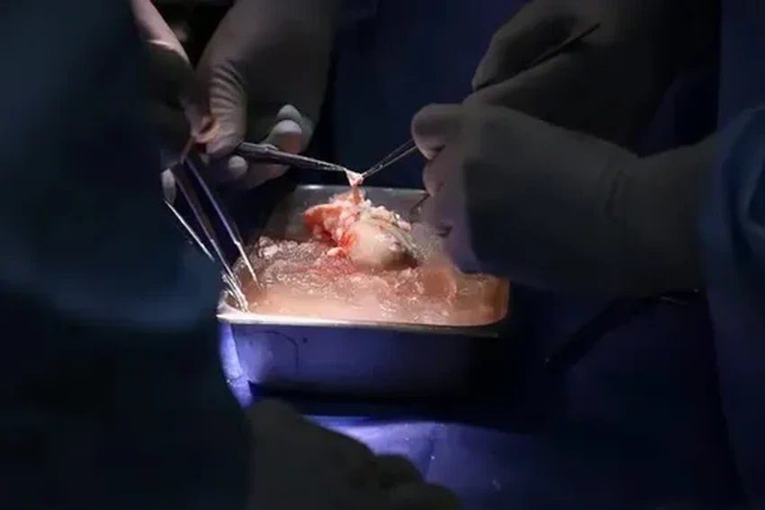 Первая в мире пересадка свиной печени живому пациенту: детали операции