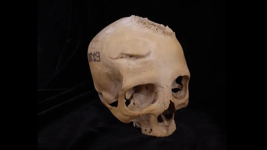 Хирургия рака в Древнем Египте: операции проводили более 4000 лет назад