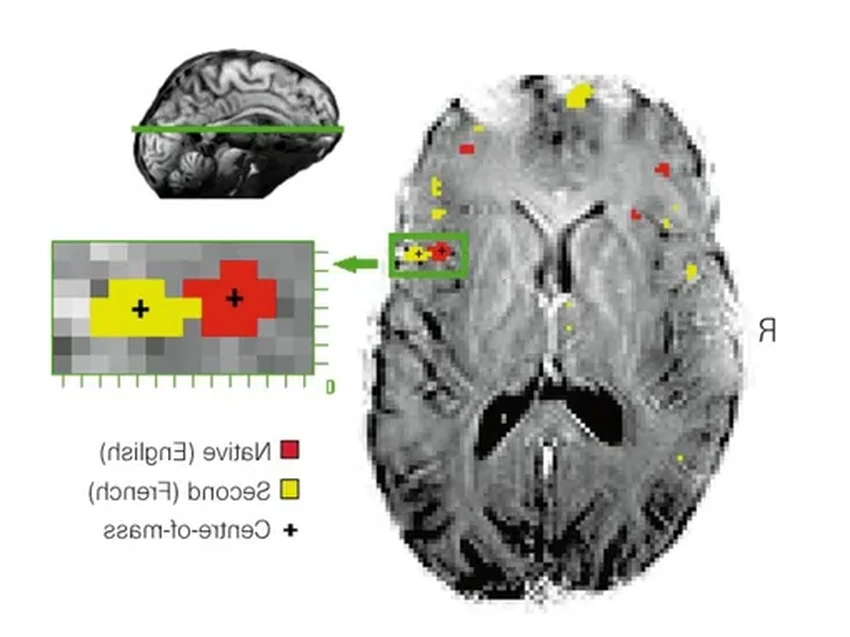 Как мозговой имплант вернул речь и два языка человеку после инсульта