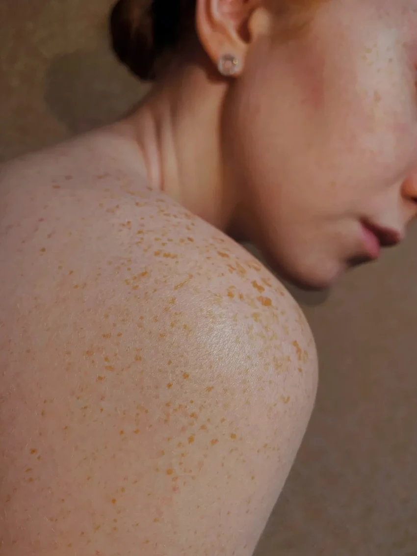 Низкая стрессоустойчивость повышает риск развития псориаза, выяснили ученые