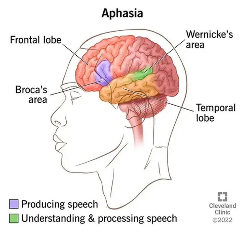 Что такое афазия: как нарушается речь после инсульта или травмы мозга