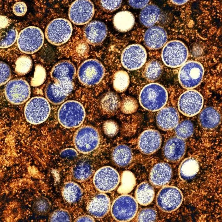 Аляскинская оспа: зафиксирована первая смерть от вируса