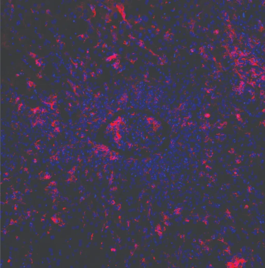 CRISPR-терапия: как редактирование генов лечит врождённый иммунодефицит