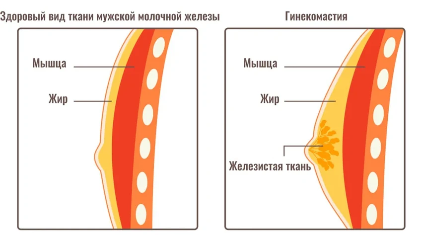 Мужская гинекомастия связана с повышенным риском преждевременной смерти