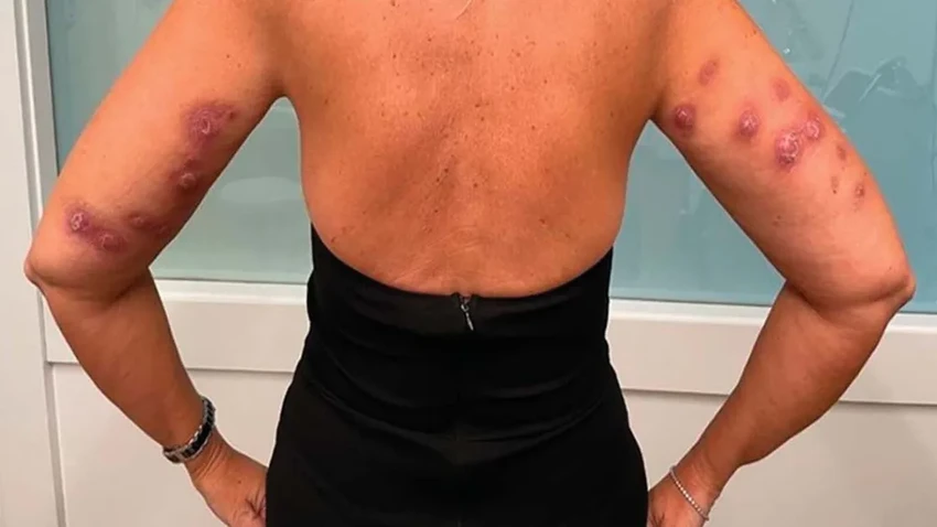 Жиросжигающие уколы: скрытые риски и предупреждение FDA