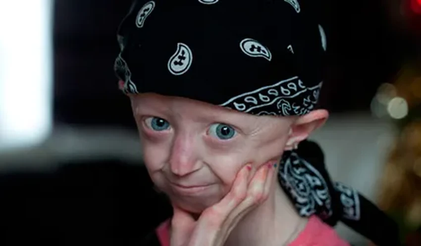 Прогерия: как живут дети, которые стареют в 10 раз быстрее всех