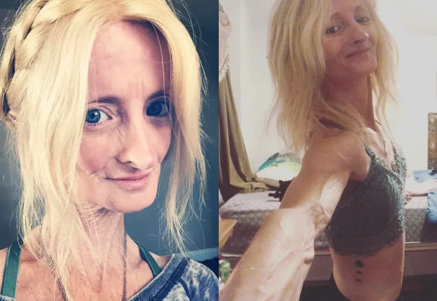 Прогерия: как живут дети, которые стареют в 10 раз быстрее всех