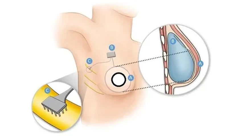 Бионическая грудь: как вернуть осязание после мастэктомии