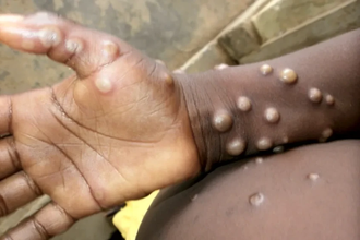 Вспышка оспы обезьян: ВОЗ объявляет международную чрезвычайную ситуацию