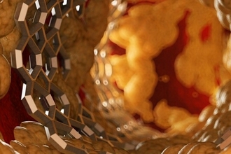 Бемпедоевая кислота: замена статинам без побочных эффектов?