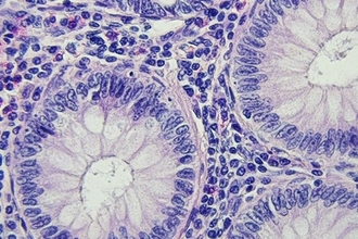 Как победить рак: отключение белка-защитника опухолевых клеток