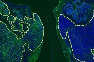 Новая двойная иммунотерапия против костных метастазов рака груди