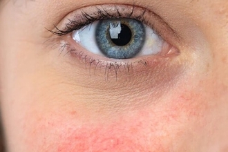 Анифролумаб против волчанки: результаты долгосрочного исследования эффективности