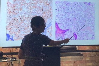 Разгадка остеосаркомы: как генетика меняет подход к лечению