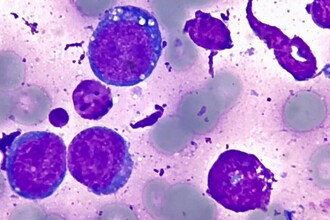 Новый подход к лечению мантийноклеточной лимфомы: перспективы терапии