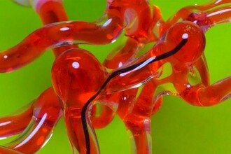 Магнитная нить-робот против инсульта: как лечат без операции