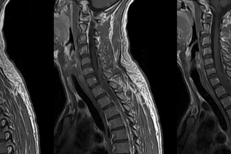 Как вернуть движение: технологии для восстановления после травм позвоночника