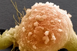 Как ИИ помогает выявить рак на ранних стадиях