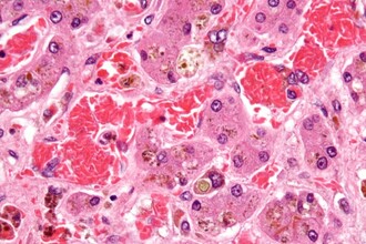 CRISPR против анемии: как редактирование генов победило болезнь крови