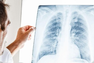 Рак лёгких у некурящих: учёные нашли отличия в опухолях и ключ к лечению
