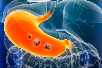 Некодирующая РНК: как молекула lincPRKD провоцирует рак желудка