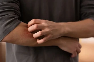 Чем снять зуд от укуса комара: аптечные и народные средства