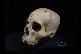 Хирургия рака в Древнем Египте: операции проводили более 4000 лет назад