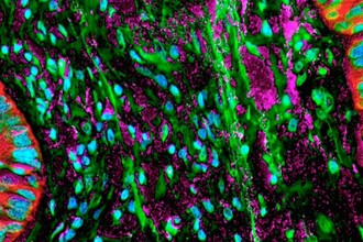 Новый препарат против рака: результаты испытаний tisotumab vedotin