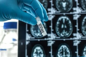 Леканемаб против Альцгеймера: результаты третьей фазы клинических испытаний