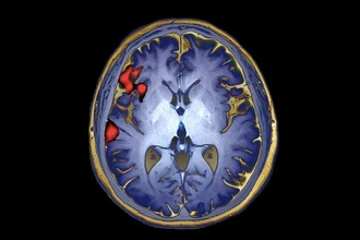 Как мозговой имплант вернул речь и два языка человеку после инсульта