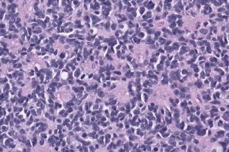 Наночастицы против детского рака мозга: как железо пробивает барьер