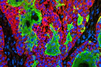 Метаболизм рака: почему старые теории требуют пересмотра