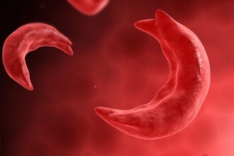 Генная терапия против анемии: как лечат серповидные клетки