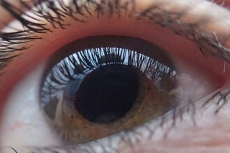 Потеря зрения при макулодистрофии: найден ли общий ключ к лечению?