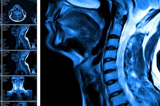 Перепрограммирование стволовых клеток: прорыв в лечении травм спинного мозга