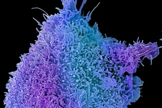 Ранняя диагностика рака: как ИИ находит предопухолевые изменения шейки матки