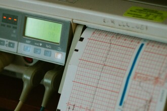 Как ЭКГ может заменить укол: новый способ контроля сахара в крови