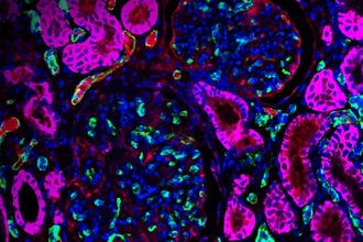 История медицины: первая пересадка генетически модифицированной свиной почки человеку