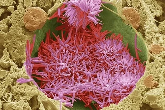 Первое редактирование генома человека против высокого холестерина: результаты