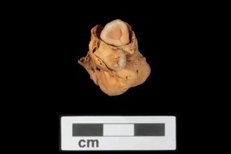 В Египте найдена древнейшая тератома: опухоль с зубами у женщины, умершей 3300 лет назад