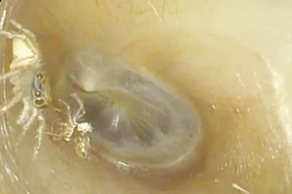Случай в ухе: паук поселился и полинял – причина странных звуков